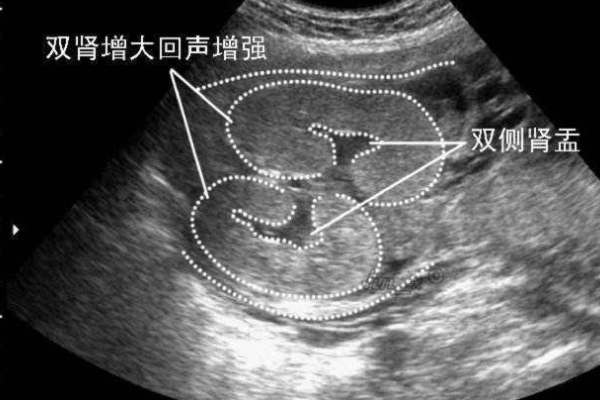 孕晚期双侧肾盂分离超过1mm说明胎儿百分之99是男孩吗？