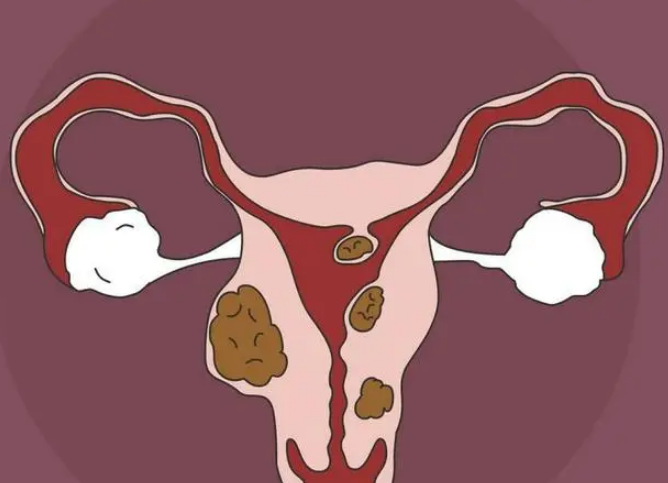始基子宫是胎儿时期染色体异常引起的畸变吗？
