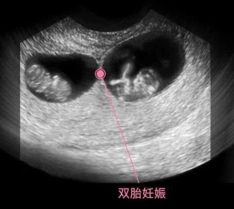 两个孕囊在孕初期一大一小是怀龙凤胎的特征吗？
