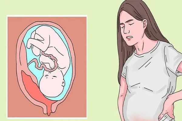 孕15周胎盘早剥身体有什么感觉吗?