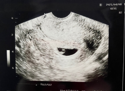 怀孕六周多就有胎心胎芽的最后都是生的男孩吗？