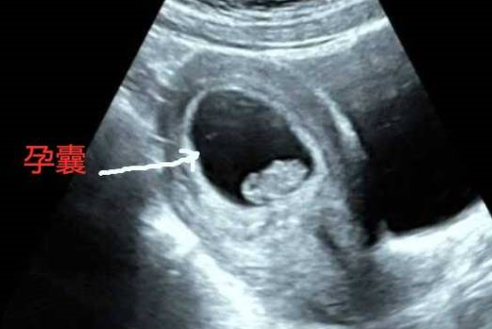 孕囊呈现不规则的形状很有可能是由胎儿异常导致的