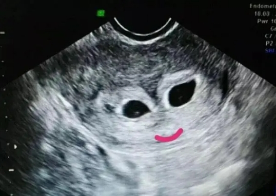 怀孕50天做b超孕囊一长一圆代表是龙凤胎吗？