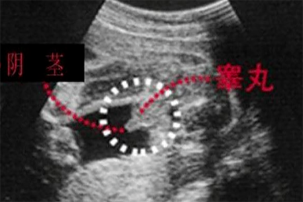 孕18周胎儿小鸡彩超图是什么样子的?