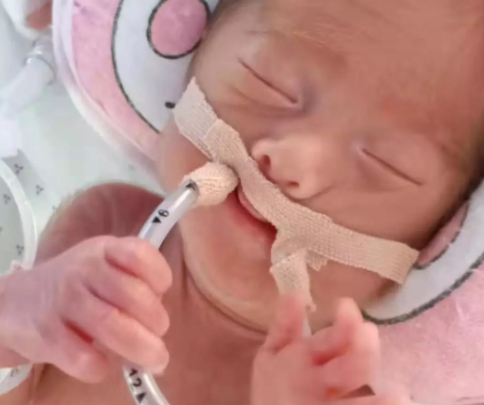 早产儿出生后就插上呼吸机说明基本都活不了吗？