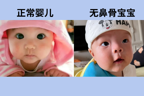 无鼻骨宝宝和正常婴儿有什么区别，求对比图分享