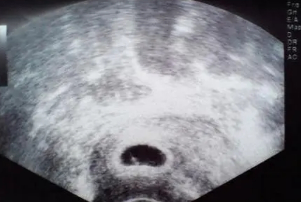 怀孕5周孕囊大小多少正常，有参考图片嘛？